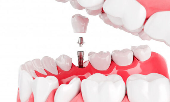 Zobni implantati Lux dental